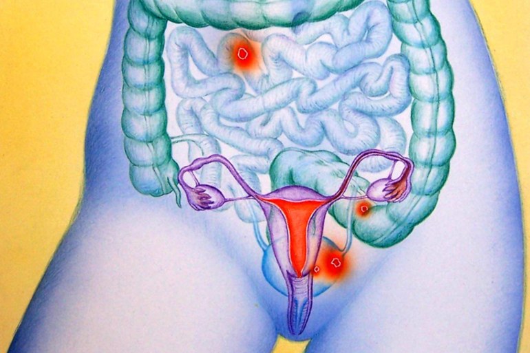 Endometriose: Meine Gebärmutter ist nicht euer Mittags-Snack