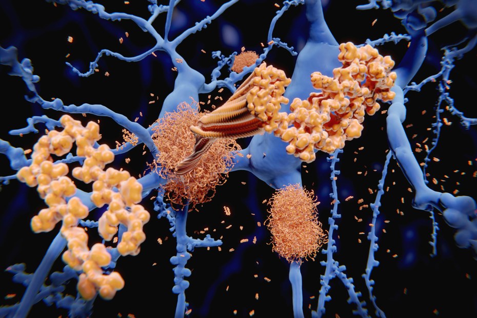 Der monoklonale Antikörper Lecanemab wirkt, indem es das Gehirn von Ablagerungen von Beta-Amyloid befreit